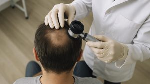 Examen clínico del cuero cabelludo en preparación para un implante capilar con resultados naturales, enfocado en identificar las causas de la alopecia areata desde el origen.
